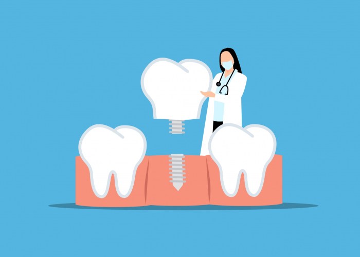 Dental implants